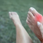 FAQs About Bunions