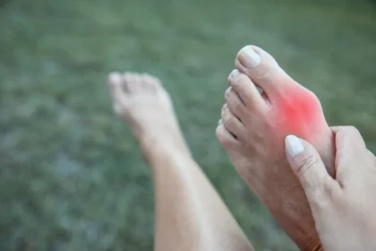 FAQs About Bunions