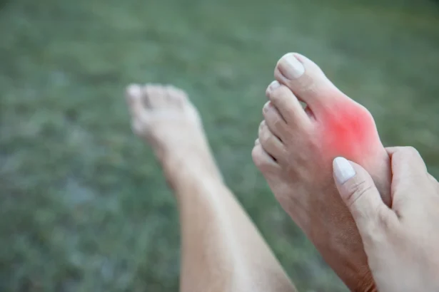FAQs About Bunions