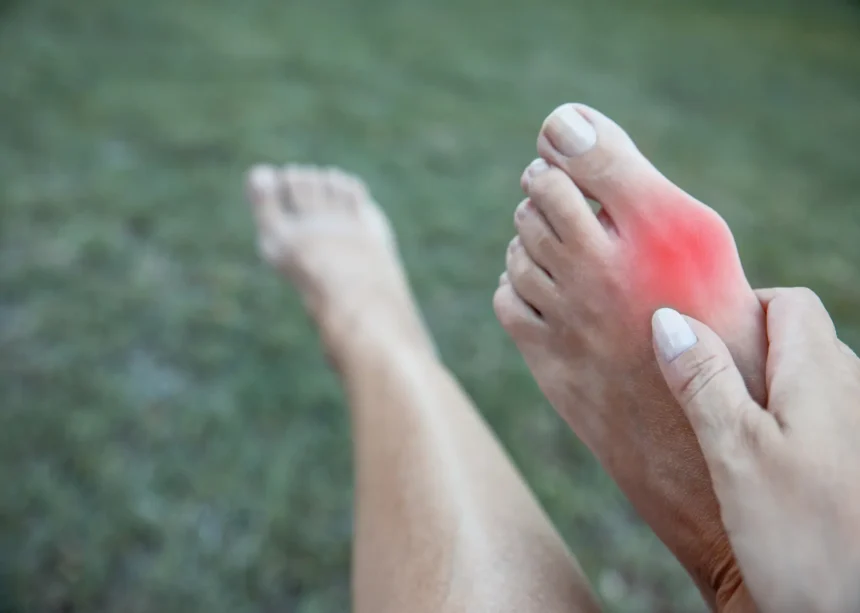 FAQs About Bunions