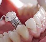How To Prepare for Your Appointment With a Dental Implant Specialist