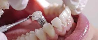 How To Prepare for Your Appointment With a Dental Implant Specialist