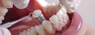 How To Prepare for Your Appointment With a Dental Implant Specialist