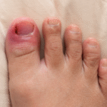 How to Treat an Ingrown Toenail Before It Becomes a Problem
