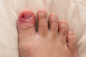 How to Treat an Ingrown Toenail Before It Becomes a Problem