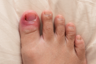 How to Treat an Ingrown Toenail Before It Becomes a Problem