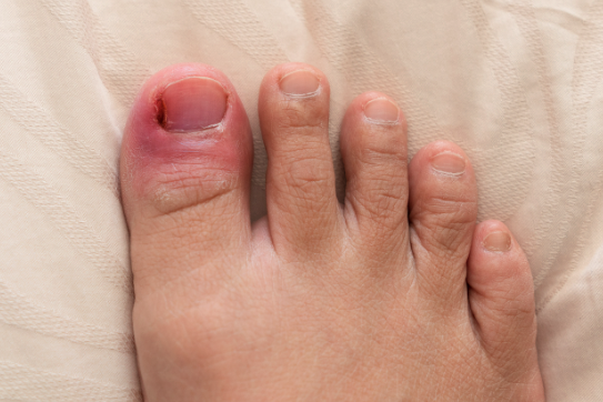 How to Treat an Ingrown Toenail Before It Becomes a Problem