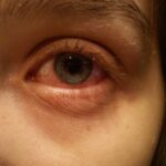 Causes, Symptoms, and When to Seek Help for Cysts on the Eye