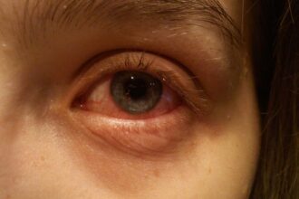 Causes, Symptoms, and When to Seek Help for Cysts on the Eye