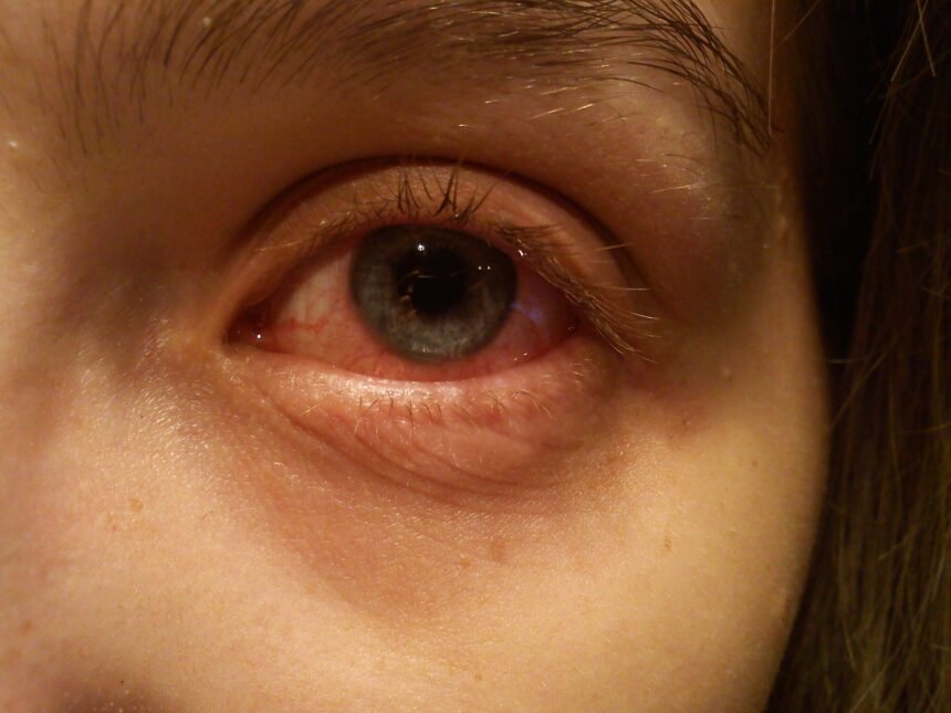Causes, Symptoms, and When to Seek Help for Cysts on the Eye