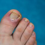 Common Causes and Treatments for Ingrown Toenails