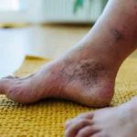 Daily Habits That Can Improve Diabetic Foot Care