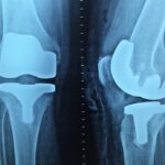 Exploring the Role of Urgent Care for Broken Bones in Community Health