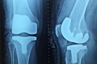 Exploring the Role of Urgent Care for Broken Bones in Community Health