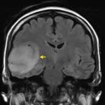 How Brain Surgeons Determine the Risk of Brain Tumors