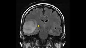 How Brain Surgeons Determine the Risk of Brain Tumors