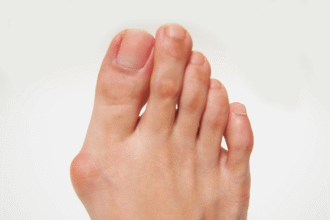 How Bunions Affect Your Overall Foot Health