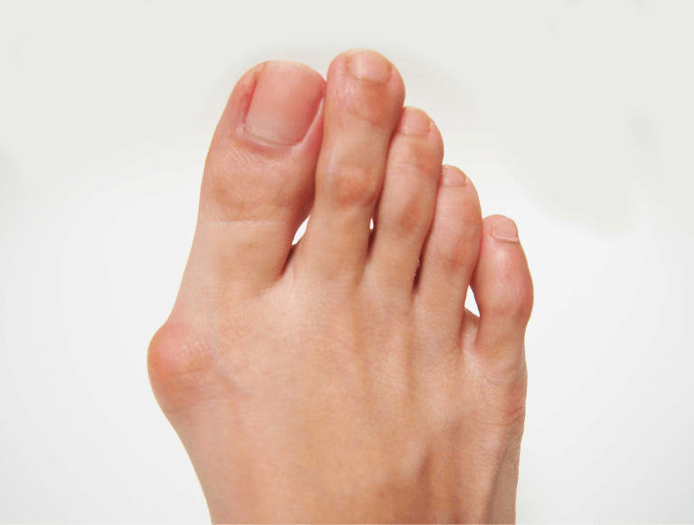How Bunions Affect Your Overall Foot Health