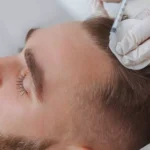 How PRP Therapy Can Enhance Your Aesthetic Treatments