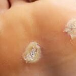 How Podiatrists Treat and Prevent Warts