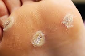 How Podiatrists Treat and Prevent Warts