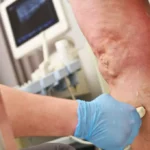 How Vein Care Can Help Reduce the Risk of Blood Clots and Swelling
