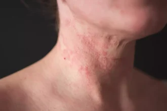 How a Skin Doctor Approaches Skin Allergies and Irritations