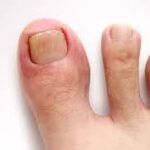 How to Spot an Ingrown Toenail Before It Gets Worse