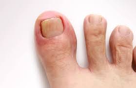 How to Spot an Ingrown Toenail Before It Gets Worse