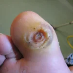 Innovative Techniques in Wound Care for Faster Recovery