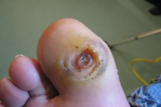 Innovative Techniques in Wound Care for Faster Recovery