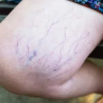 Lifestyle Changes to Prevent and Treat Varicose Veins