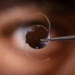 Preparing for Your Cataract Surgery Consultation