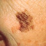 Recognizing the Early Signs of Skin Cancer