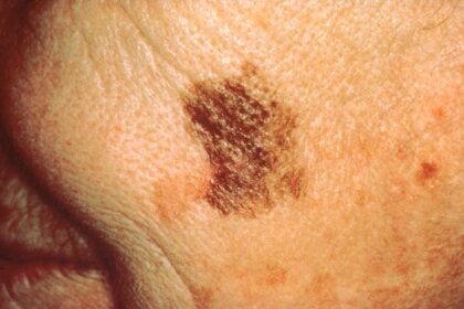 Recognizing the Early Signs of Skin Cancer