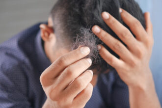 The Benefits of Different Types of Hair Loss Treatments