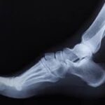 The Role of Non-surgical Treatments in Managing Neuroma Pain