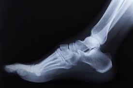 The Role of Non-surgical Treatments in Managing Neuroma Pain