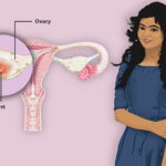 Understanding Ovarian Cysts and How To Treat Them