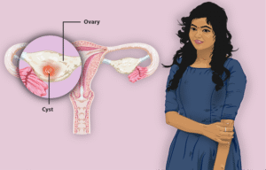 Understanding Ovarian Cysts and How To Treat Them