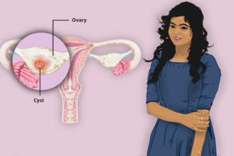 Understanding Ovarian Cysts and How To Treat Them