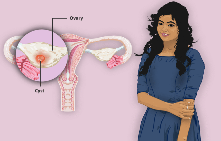 Understanding Ovarian Cysts and How To Treat Them