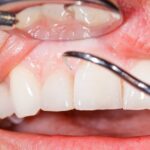 Understanding the Importance of Gum Treatments in Dental Care