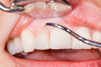 Understanding the Importance of Gum Treatments in Dental Care