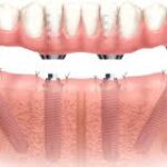 What Are the Benefits of Dental Implants Over Bridges and Dentures?