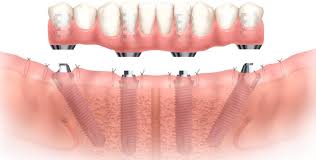 What Are the Benefits of Dental Implants Over Bridges and Dentures?