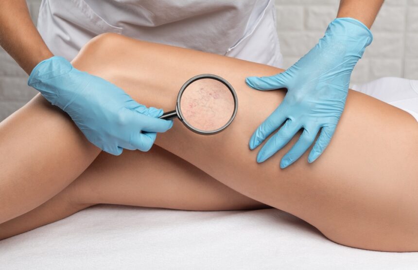 What Can a Vascular Specialist Do for My Varicose Veins?