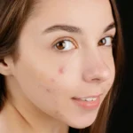 What Causes Lipomas and When Should You See a Dermatologist?