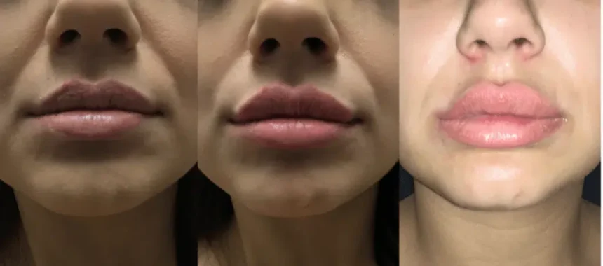 What To Expect During Your Lip Laser Treatment Session