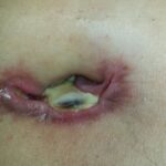 What to Expect Before, During, and After Hernia Surgery